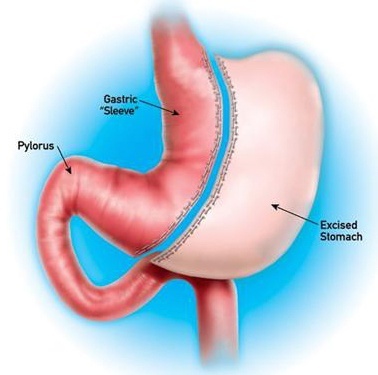 Bariatric Surgery & Malnutrition