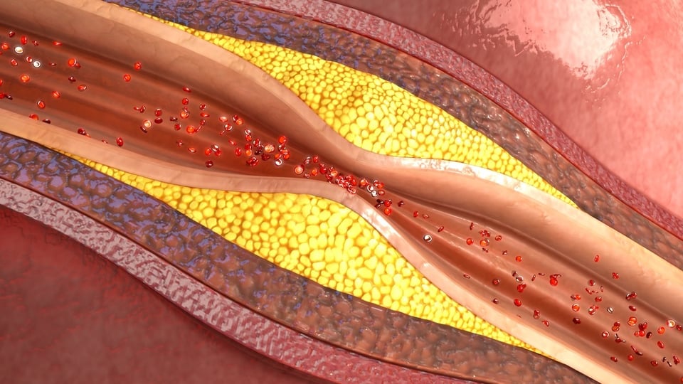 Recent Review Explores Relationship Between Probiotics and Atherosclerosis