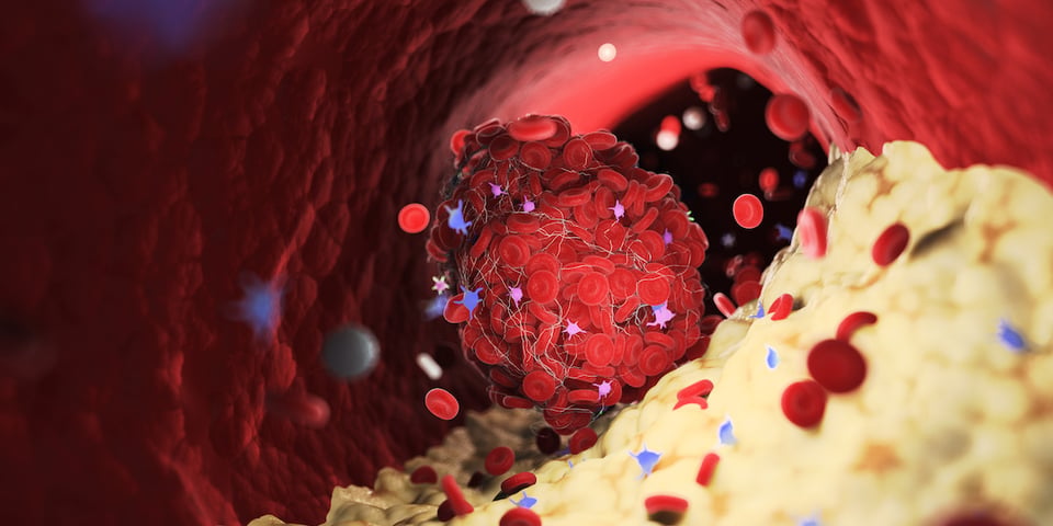 Recent Clinical Trial Investigates Potential Role of Nattokinase in Cardiovascular Health