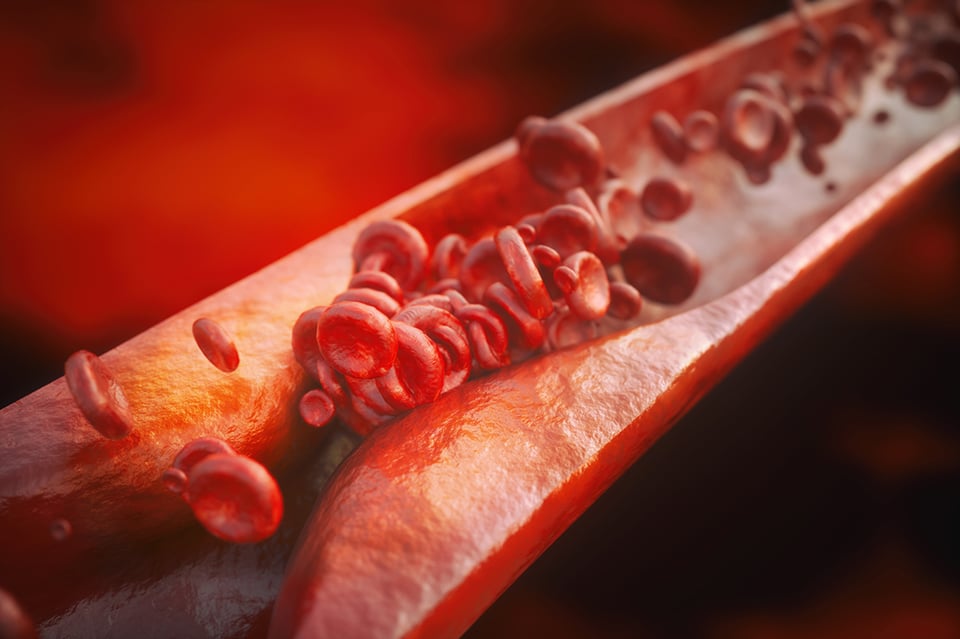 Can an Overactive Immune Response Lead to Atherosclerosis?