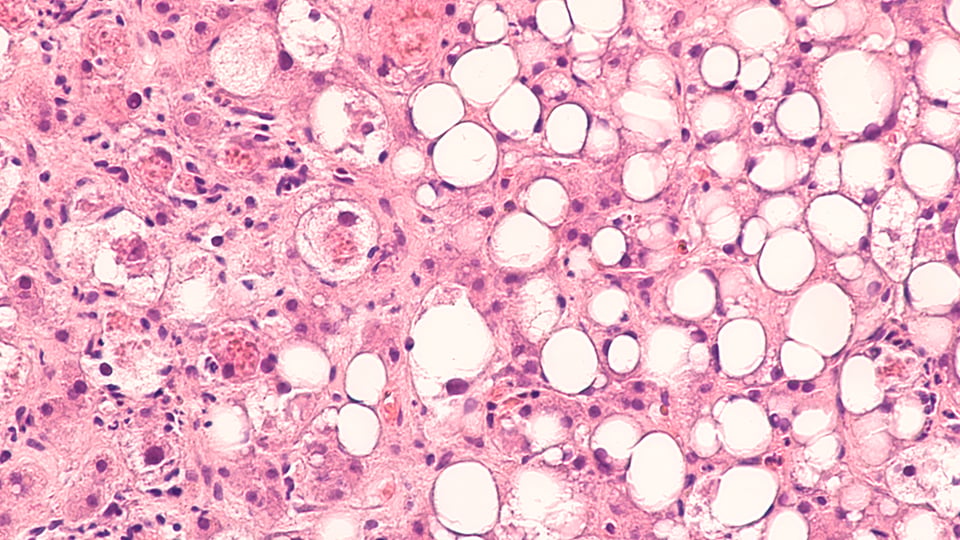 Recent Randomized Clinical Trial Compares Efficacy of Delta-Tocotrienol and Alpha-Tocopherol in Liver Health