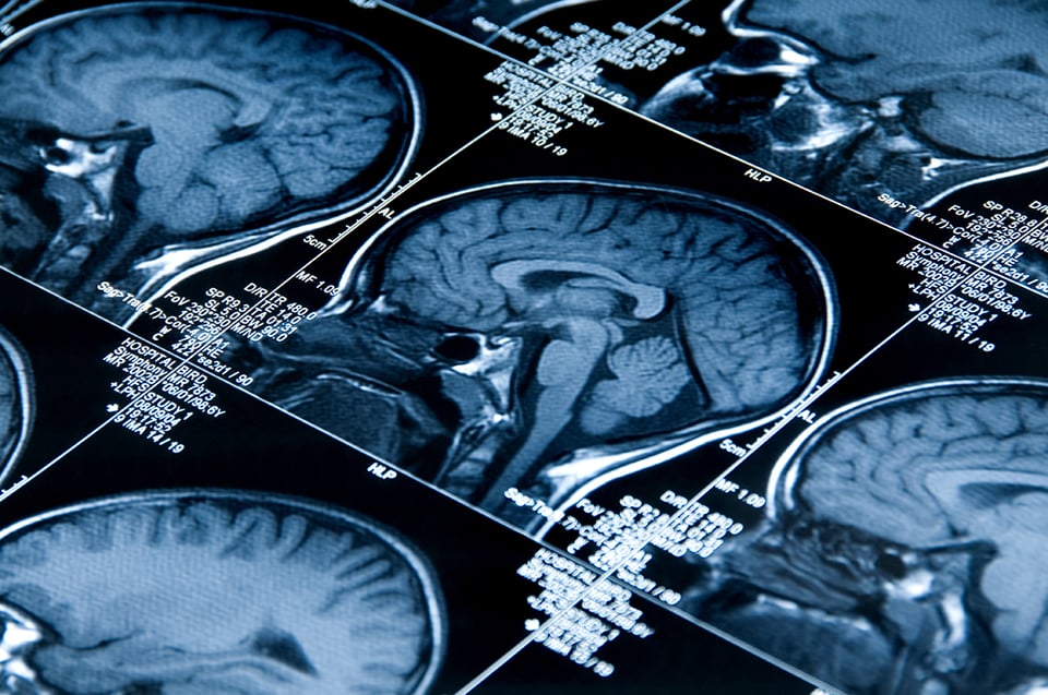 Recent Review Explores the Roles of Certain Nutrients in the Risk of Developing of Alzheimer’s Disease