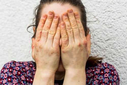 Getting to the Root of Eczema
