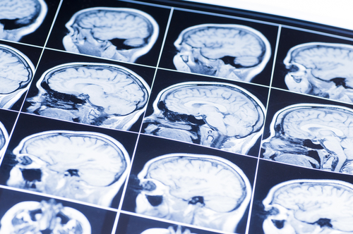 Is There a Role for Ketones in Traumatic Brain Injury?