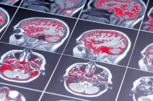 GPC & TBI…Connecting the Dots