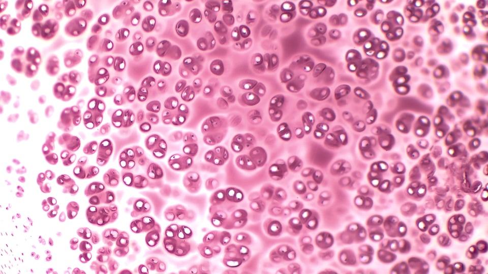 Research Review: Glucosamine and Chondroitin in Osteoarthritis