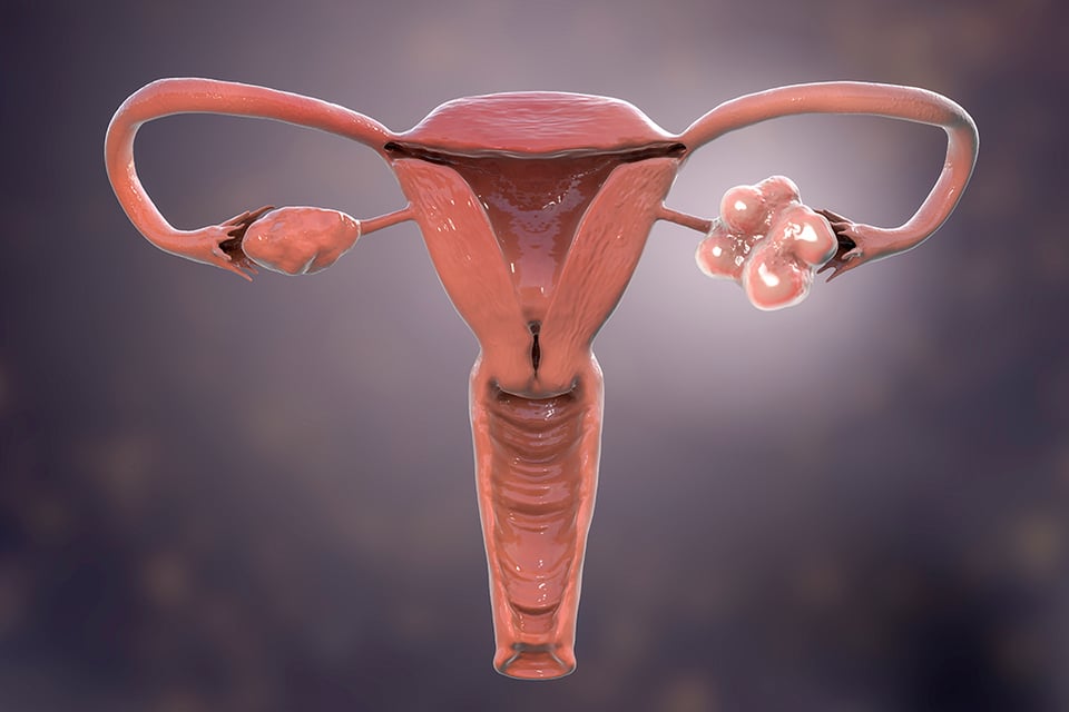 Investigating the Role of Inositol in PCOS