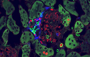 Autoimmune Disease What Lies Beneath