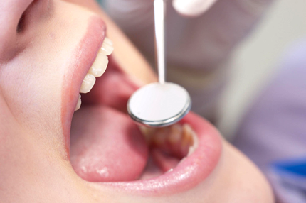Battling Canker Sores