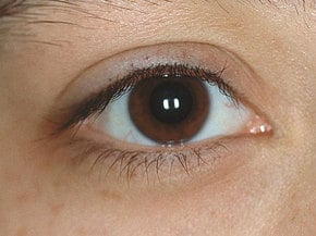 Glaucoma: Reducing the Risks Through Diet and Nutrition