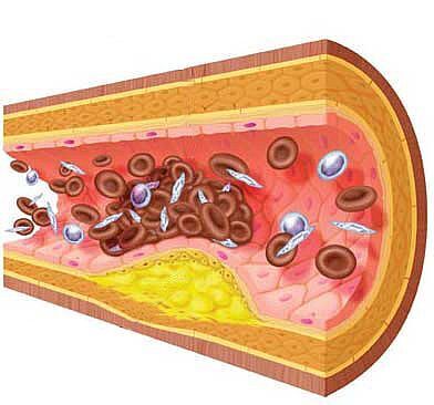 Addressing Arteriosclerosis