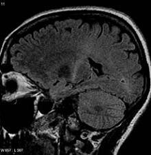 ALS and Complementary Medicine