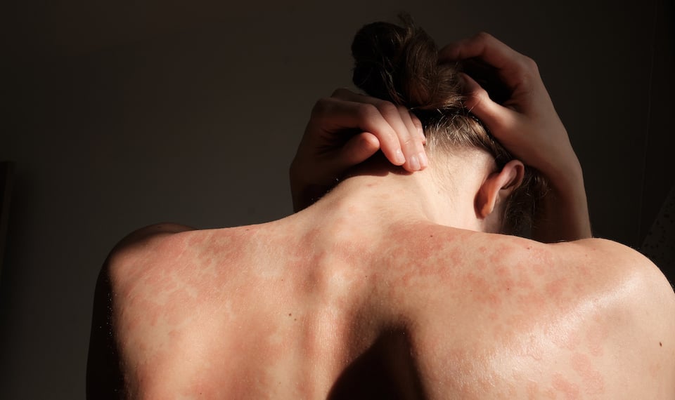 Recent Trial Investigates Potential Link Between Vitamin D, PUFAs, and Autoimmunity